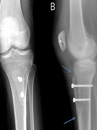Asetabulum Displazi Supramalleolar Asetabulum Displazi Supramalleolar