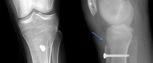 Asetabulum Displazi Supramalleolar