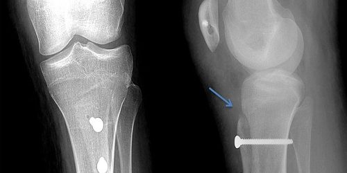 Asetabulum Displazi Supramalleolar Asetabulum Displazi Supramalleolar