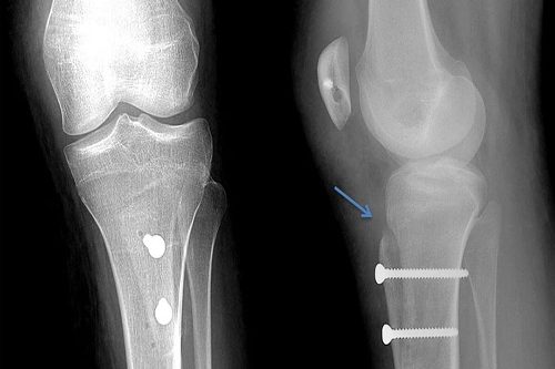 Asetabulum Displazi Supramalleolar Asetabulum Displazi Supramalleolar