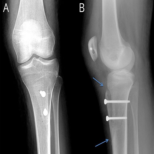 Asetabulum Displazi Supramalleolar Asetabulum Displazi Supramalleolar