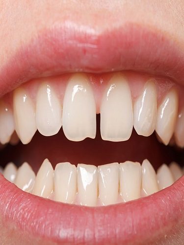 Aralıklı Dişlerin Tedavisi (Diastema) Aralıklı Dişlerin Tedavisi (Diastema)