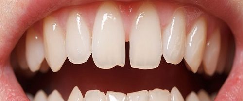 Aralıklı Dişlerin Tedavisi (Diastema)