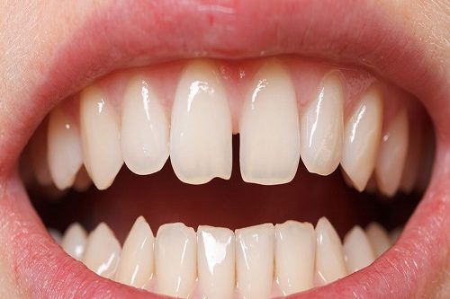 Aralıklı Dişlerin Tedavisi (Diastema)
