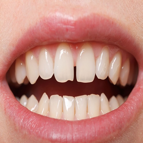 Aralıklı Dişlerin Tedavisi (Diastema) Aralıklı Dişlerin Tedavisi (Diastema)