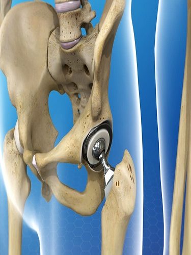 Arthroplasti Arthroplasti