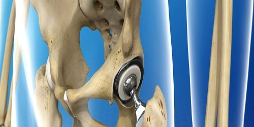 Arthroplasti Arthroplasti