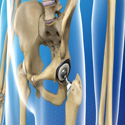 Arthroplasti Arthroplasti