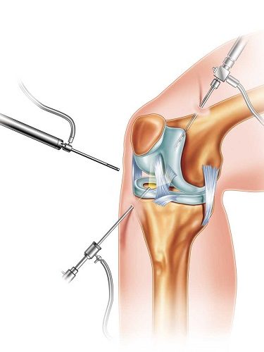 Artroskopik Osteotomi Cerrahisi Artroskopik Osteotomi Cerrahisi