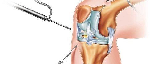 Artroskopik Osteotomi Cerrahisi