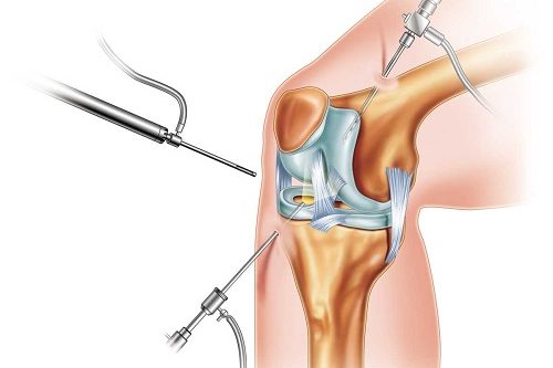 Artroskopik Osteotomi Cerrahisi Artroskopik Osteotomi Cerrahisi