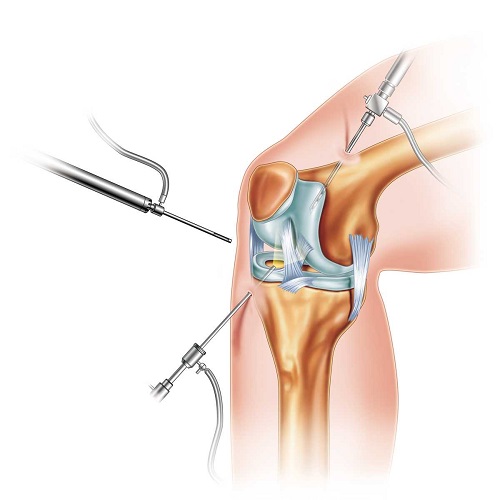 Artroskopik Osteotomi Cerrahisi Artroskopik Osteotomi Cerrahisi