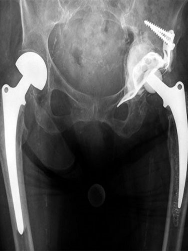 Asetobuloplasti Asetobuloplasti