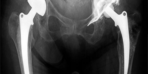 Asetobuloplasti Asetobuloplasti