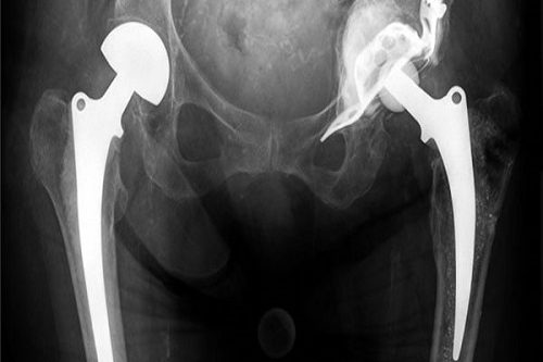 Asetobuloplasti Asetobuloplasti