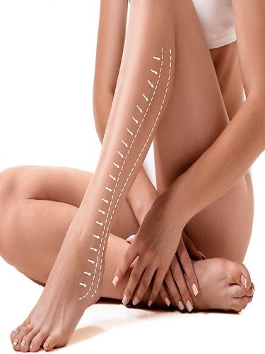 Bacak Estetiği Bacak Estetiği