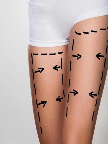 Bacak Germe Ameliyatı Bacak Germe Ameliyatı