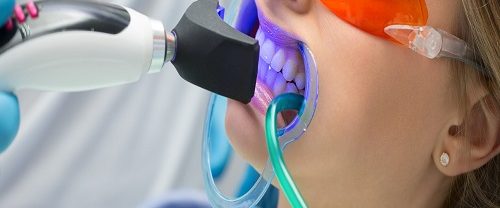 Diş Beyazlatma Bleaching