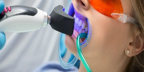Diş Beyazlatma Bleaching Diş Beyazlatma Bleaching
