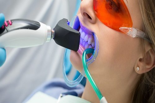 Diş Beyazlatma Bleaching