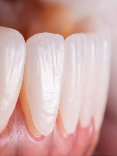 Diş Kaplama Diş Kaplama