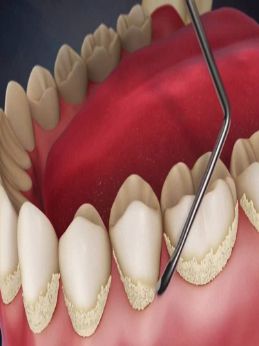 Diş Taşı Temizliği Diş Taşı Temizliği