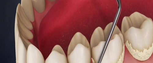 Diş Taşı Temizliği