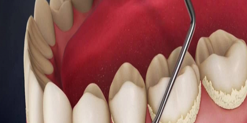 Diş Taşı Temizliği