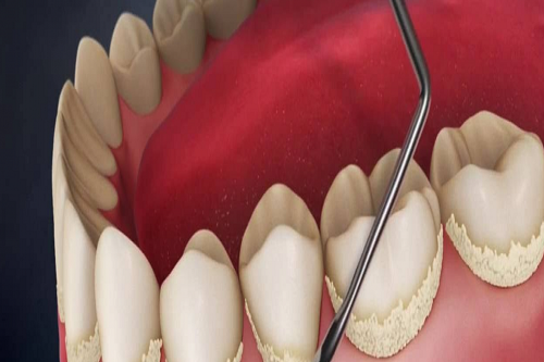 Diş Taşı Temizliği