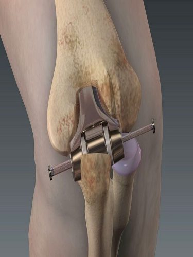 Diz Artroskopisi Diz Artroskopisi