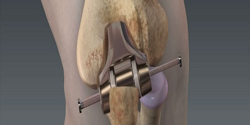 Diz Artroskopisi Diz Artroskopisi