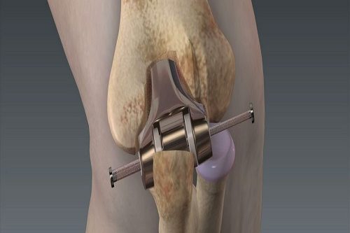 Diz Artroskopisi Diz Artroskopisi