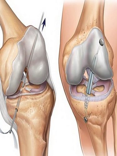 Osteokondral Greft Transfer Sistemi Osteokondral Greft Transfer Sistemi