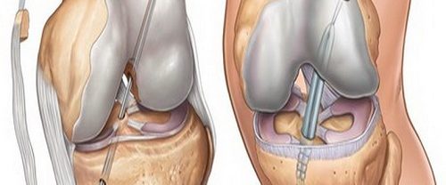Osteokondral Greft Transfer Sistemi