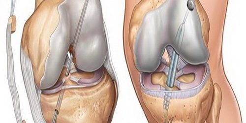 Osteokondral Greft Transfer Sistemi Osteokondral Greft Transfer Sistemi