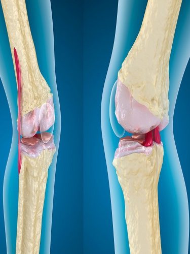 Osteoartrit Osteoartrit