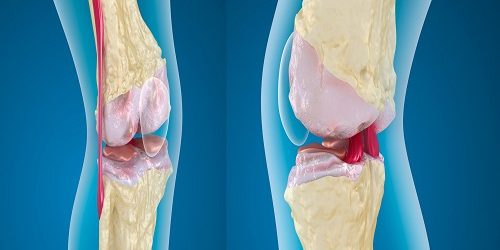 Osteoartrit Osteoartrit