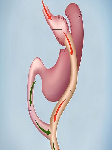 Gastrik Bypass Ameliyatı Gastrik Bypass Ameliyatı