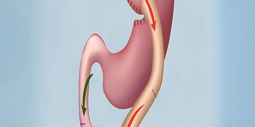 Gastrik Bypass Ameliyatı