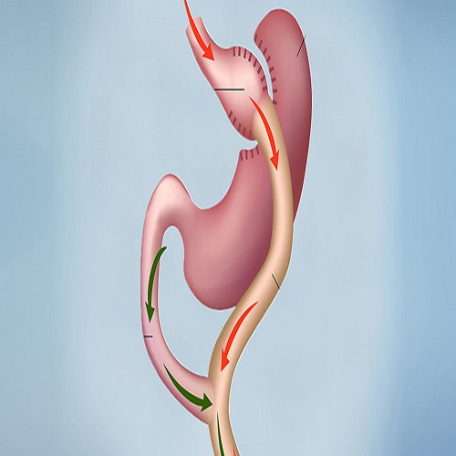 Gastrik Bypass Ameliyatı