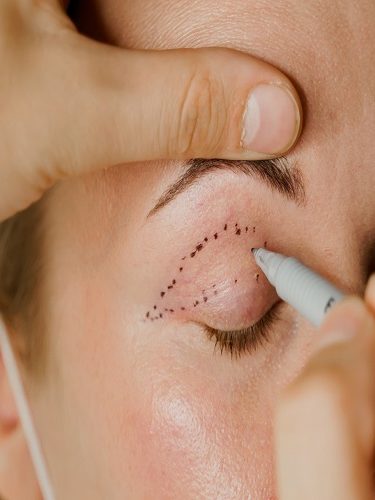 Göz Altı Torbası Ameliyatı Göz Altı Torbası Ameliyatı