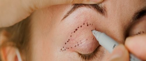 Göz Altı Torbası Ameliyatı