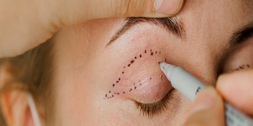 Göz Altı Torbası Ameliyatı Göz Altı Torbası Ameliyatı