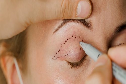 Göz Altı Torbası Ameliyatı