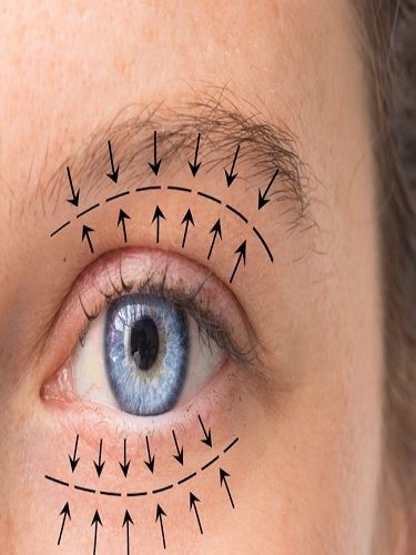 Göz Kapağı Estetiği Blefaroplasti Göz Kapağı Estetiği Blefaroplasti