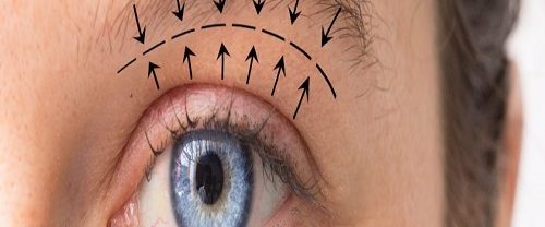 Göz Kapağı Estetiği Blefaroplasti