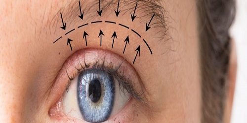 Göz Kapağı Estetiği Blefaroplasti