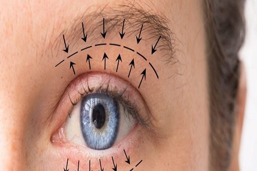 Göz Kapağı Estetiği Blefaroplasti