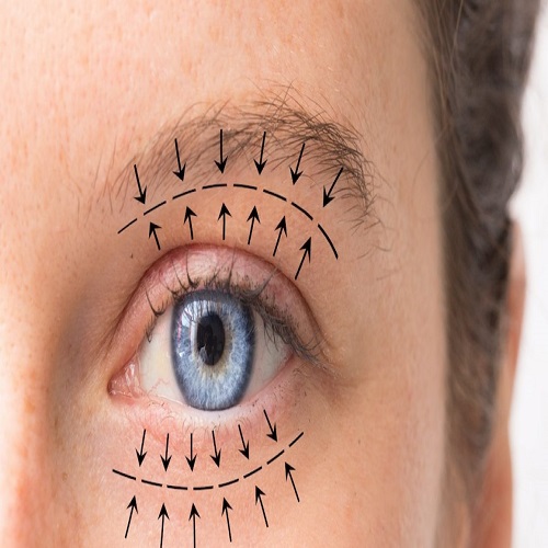 Göz Kapağı Estetiği Blefaroplasti