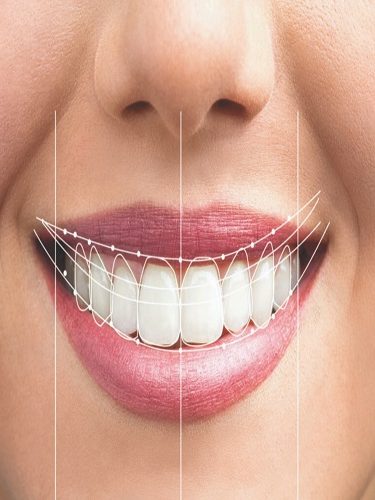 Gülüş Estetiği Gülüş Estetiği